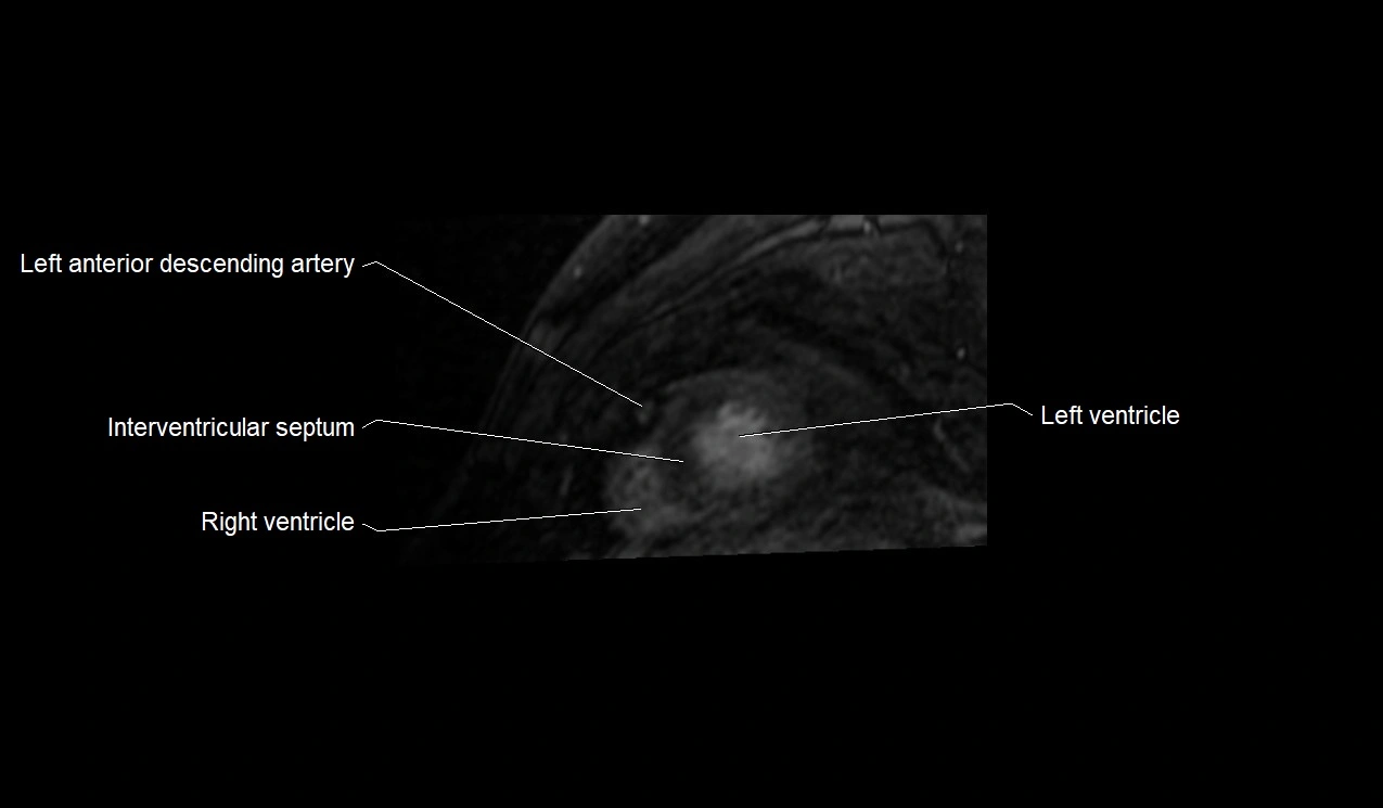 MRI heart and coronary arteries short axis anatomy image 36.webp